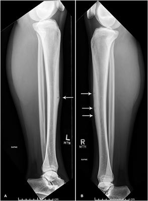 Concurrent Bilateral Anterior Tibial Stress Fractures and Vitamin D Deficiency in an Adolescent Female Athlete: Treatment With Early Surgical Intervention